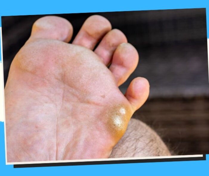 Athletes Foot