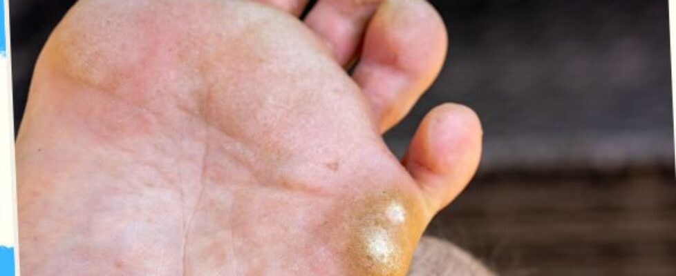 Athletes Foot
